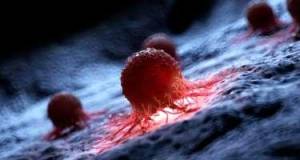 Ən ölümcül xərçəng növü açıqlandı