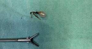 Azyaşlının bronx mənfəzində metal əşya aşkarlandı -FOTO