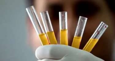 Dünyada cəmi 50 nəfər bu qana sahibdir